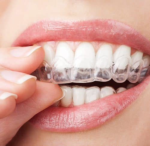 invisalign braces201610